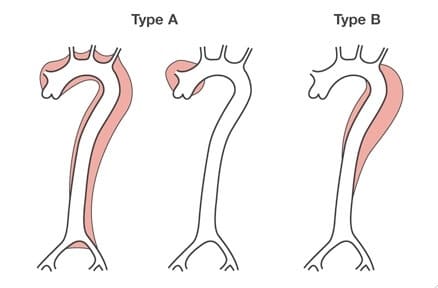 Aortic dissection classification