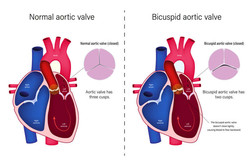 Bicuspid Aortic Valve and Aortic Dissection
