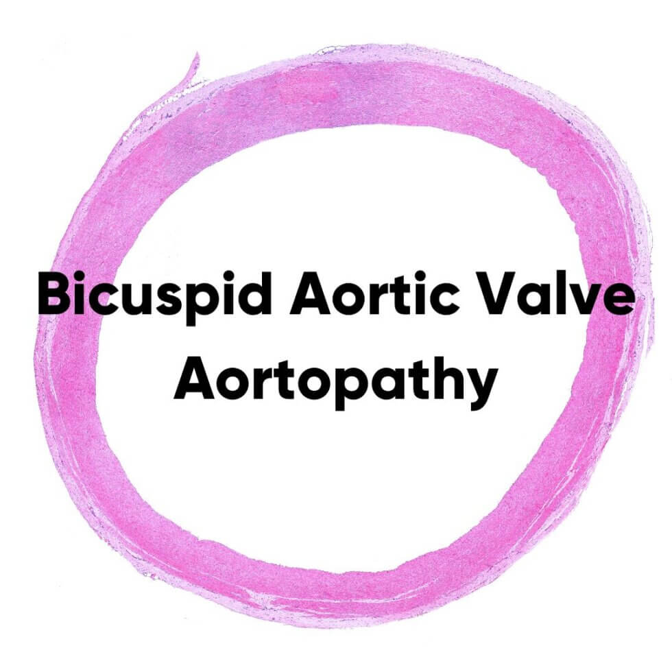 Bicuspid Aortic Valve Aortopathy