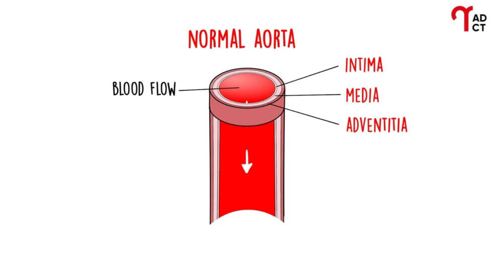 Aortic Dissection Explained Risk Factors, Symptoms, Diagnosis, FAQs