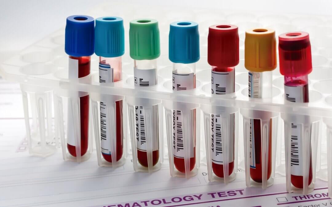 Understanding Biomarkers in Aortic Dissection